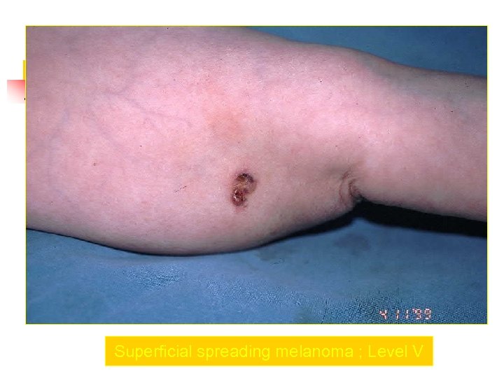 Superficial spreading melanoma ; Level V 