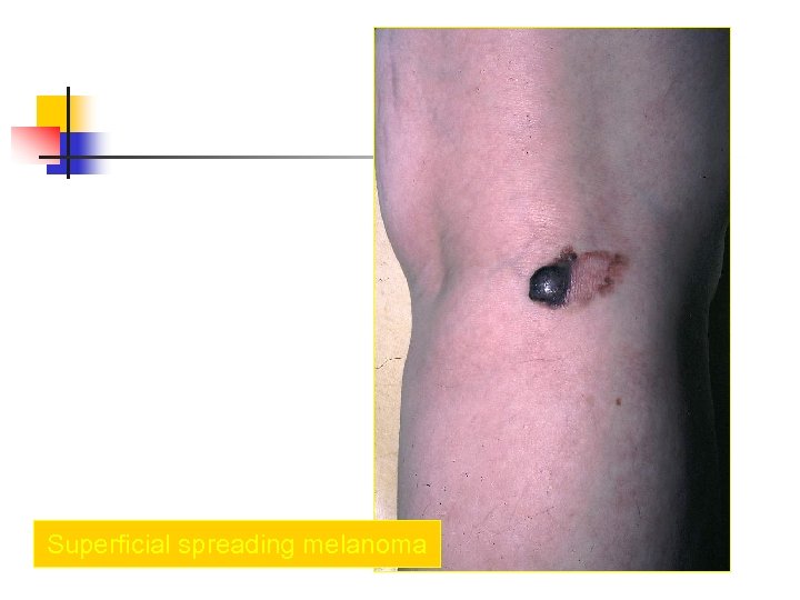 Superficial spreading melanoma 