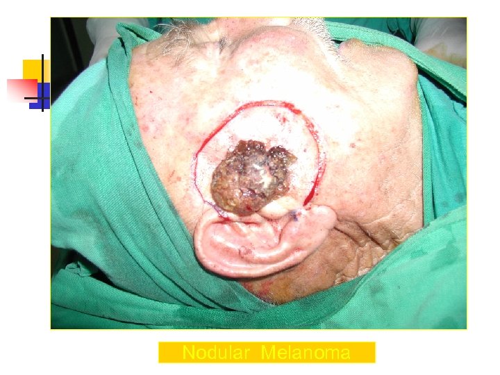 Nodular Melanoma 