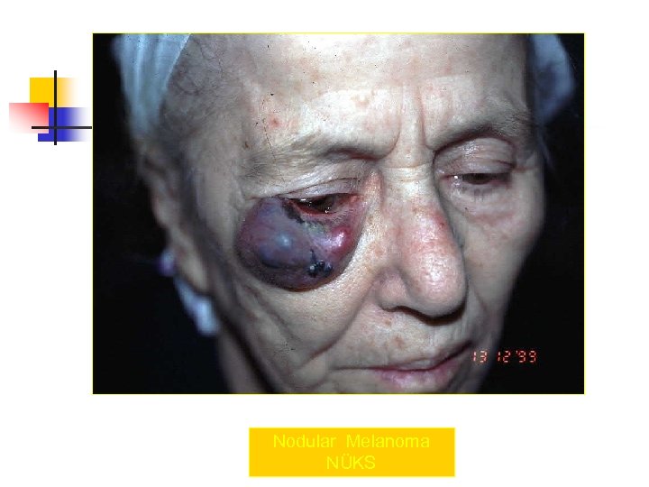 Nodular Melanoma NÜKS 