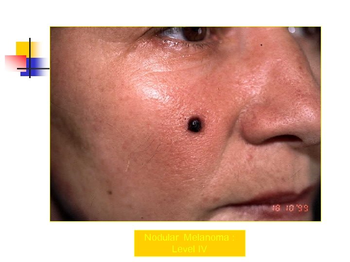 Nodular Melanoma : Level IV 