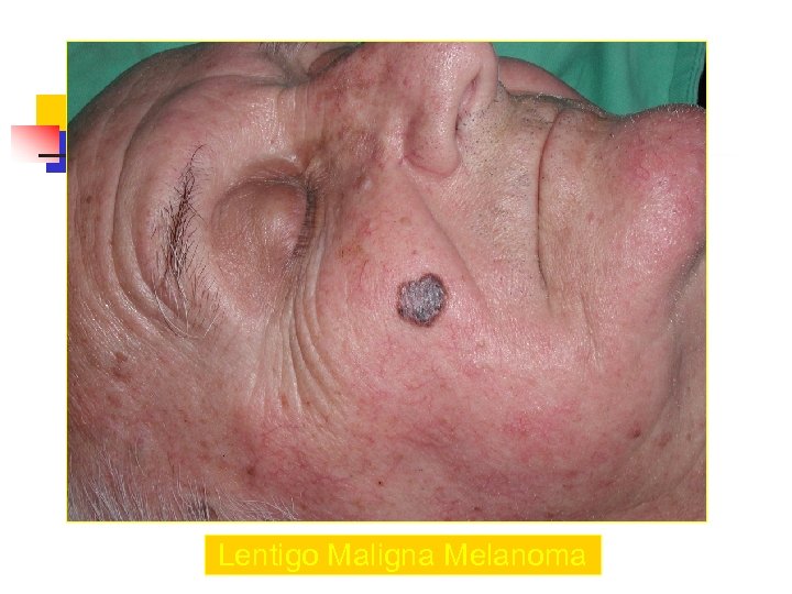 Lentigo Maligna Melanoma 