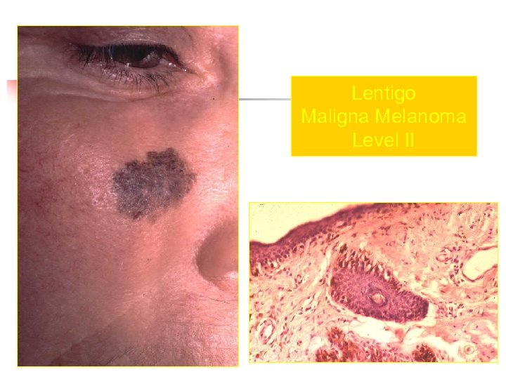 Lentigo Maligna Melanoma Level II 