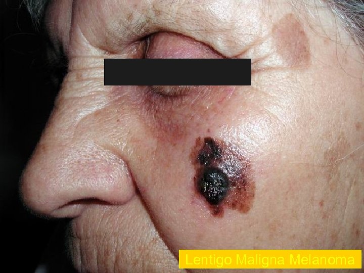 Lentigo Maligna Melanoma 