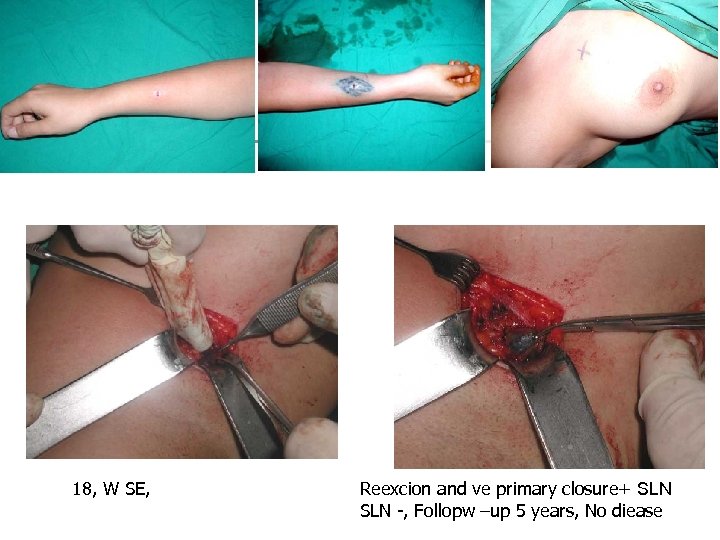 18, W SE, Reexcion and ve primary closure+ SLN -, Follopw –up 5 years,