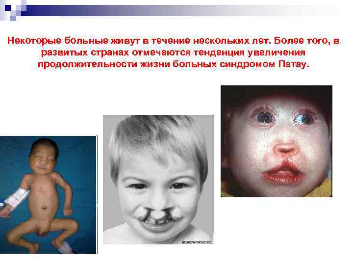 Некоторые больные живут в течение нескольких лет. Более того, в развитых странах отмечаются тенденция
