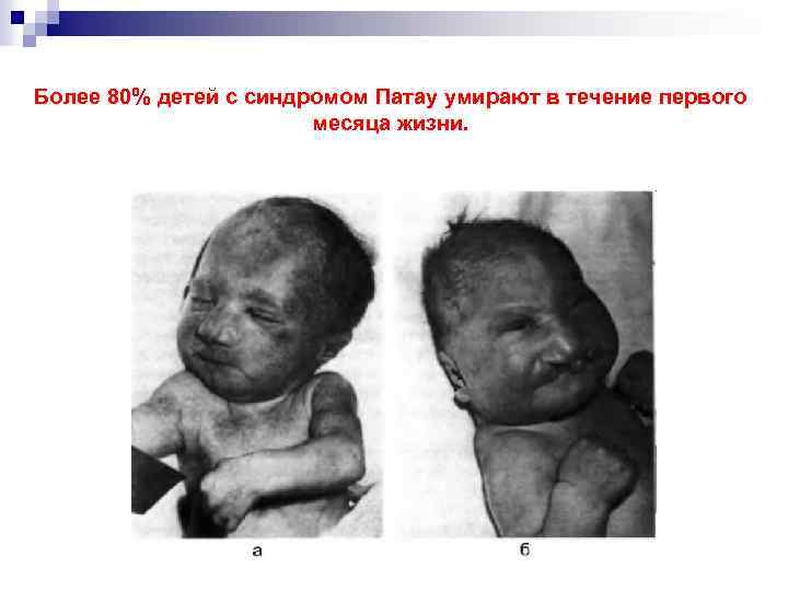 Более 80% детей с синдромом Патау умирают в течение первого месяца жизни. 