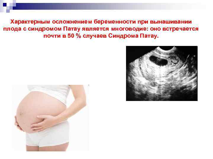 Характерным осложнением беременности при вынашивании плода с синдромом Патау является многоводие: оно встречается почти