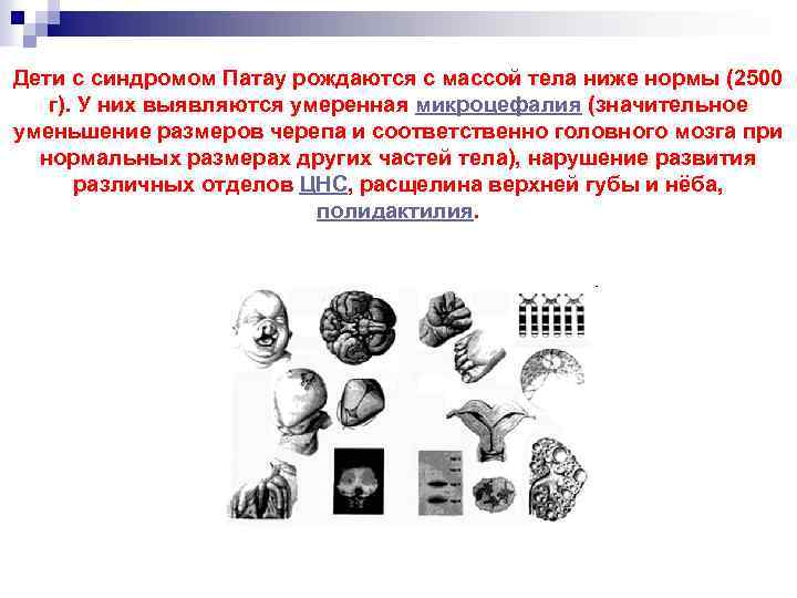 Дети с синдромом Патау рождаются с массой тела ниже нормы (2500 г). У них