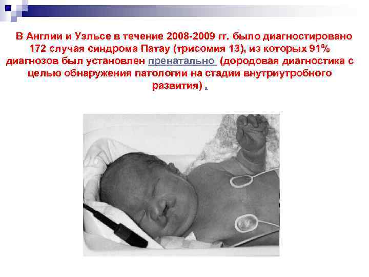  В Англии и Уэльсе в течение 2008 -2009 гг. было диагностировано 172 случая