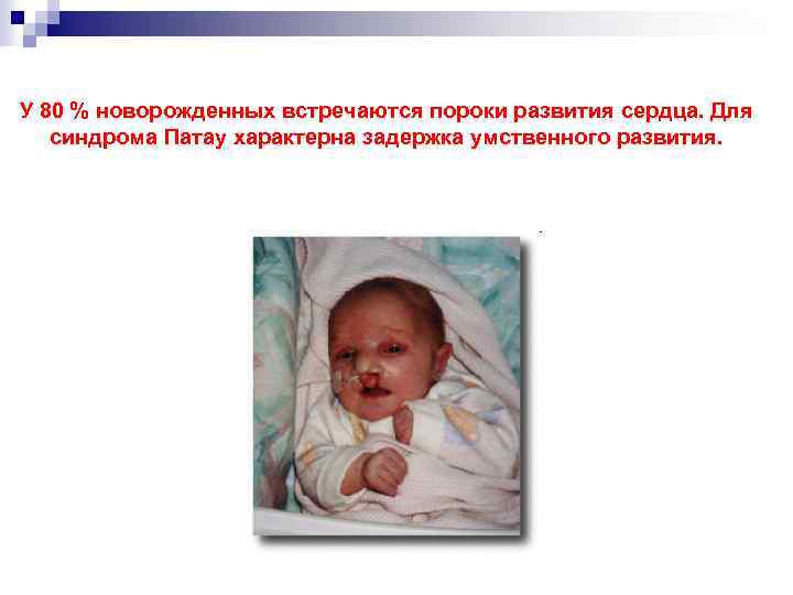 У 80 % новорожденных встречаются пороки развития сердца. Для синдрома Патау характерна задержка умственного