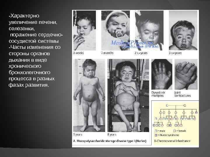 -Характерно увеличение печени, селезенки, поражение сердечнососудистой системы -Часты изменения со стороны органов дыхания в