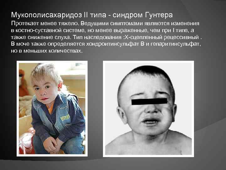 Мукополисахаридоз II типа - синдром Гунтера Протекает менее тяжело. Ведущими симптомами являются изменения в