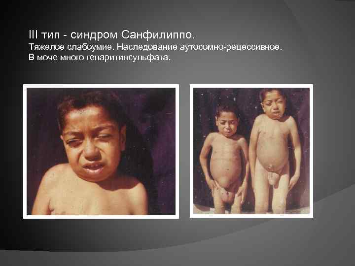 III тип - синдром Санфилиппо. Тяжелое слабоумие. Наследование аутосомно-рецессивное. В моче много гепаритинсульфата. 