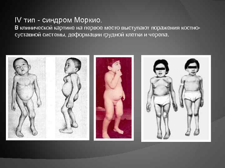 IV тип - синдром Моркио. В клинической картине на первое место выступают поражения костносуставной