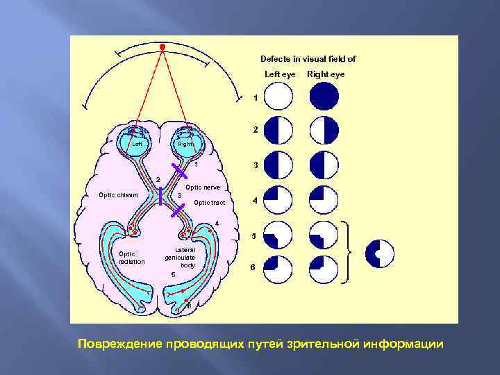 Defects in visual field of Left eye Right eye 1 2 Left Right 1