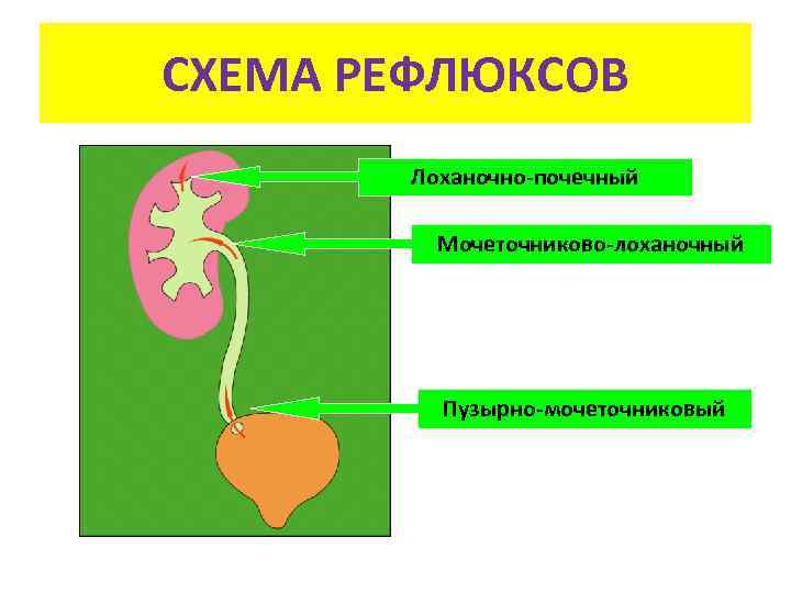 СХЕМА РЕФЛЮКСОВ Лоханочно-почечный Мочеточниково-лоханочный Пузырно-мочеточниковый 