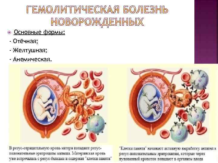 Основные формы: - Отёчная; - Желтушная; - Анемическая. 