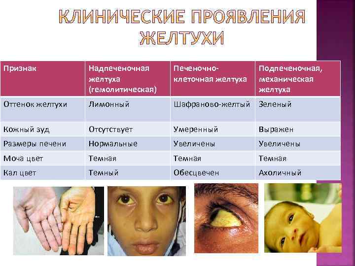 Признак Надпеченочная желтуха (гемолитическая) Печеночноклеточная желтуха Подпеченочная, механическая желтуха Оттенок желтухи Лимонный Шафраново-желтый Зеленый