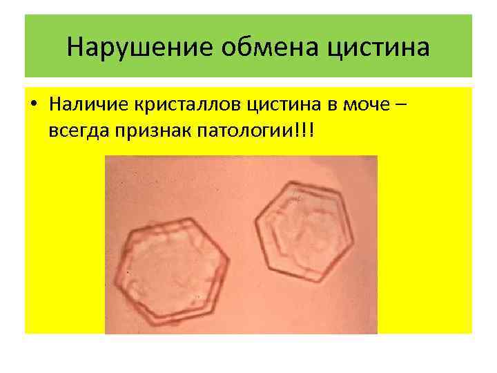 Нарушение обмена цистина • Наличие кристаллов цистина в моче – всегда признак патологии!!! 
