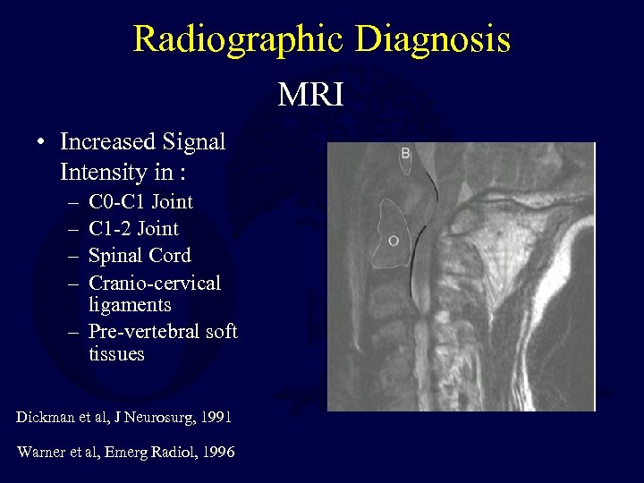 Radiographic Diagnosis MRI • Increased Signal Intensity in : – – C 0 -C