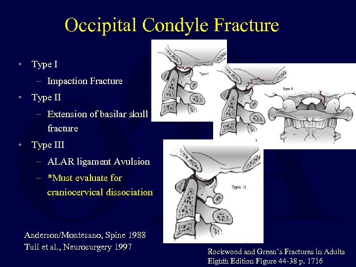 Occipital Condyle Fracture • Type I – Impaction Fracture • Type II – Extension
