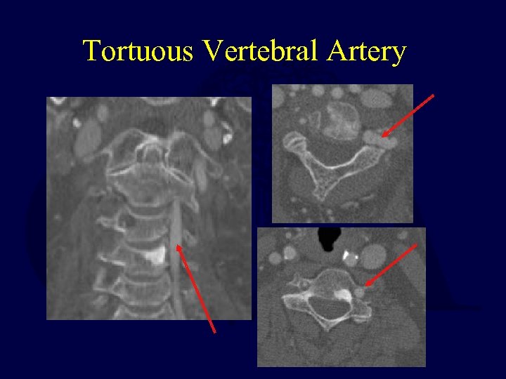Tortuous Vertebral Artery 