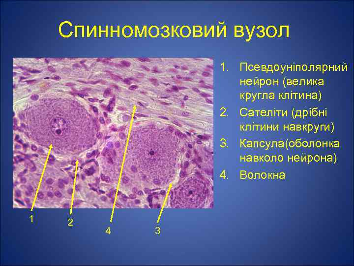 Спинномозковий вузол 1. Псевдоуніполярний нейрон (велика кругла клітина) 2. Сателіти (дрібні клітини навкруги) 3.