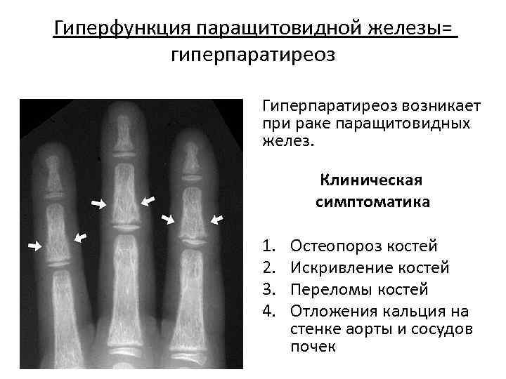 Гиперфункция паращитовидной железы. При гиперфункции паращитовидных желез наблюдается. Паращитовидная железа гипофункция и гиперфункция. Паращитовидная железа паратгормон гиперфункция. При гипофункции паращитовидной железы наблюдается.