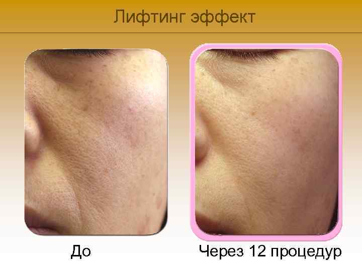 Лифтинг эффект До Через 12 процедур 