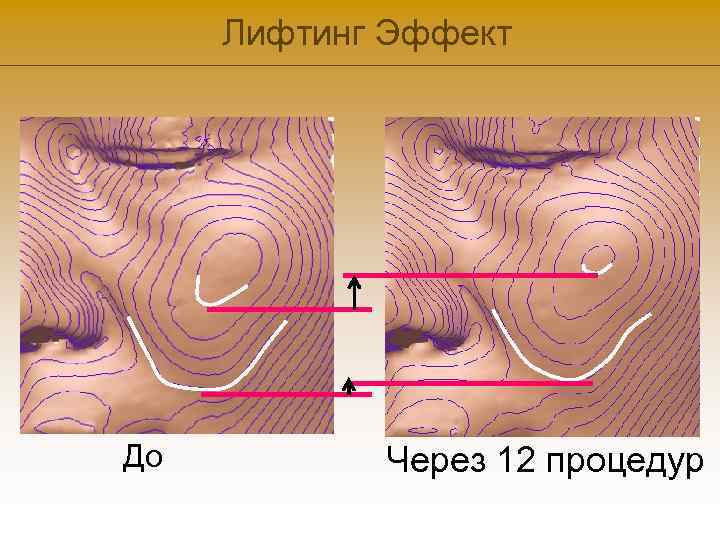 Лифтинг Эффект До Через 12 процедур 
