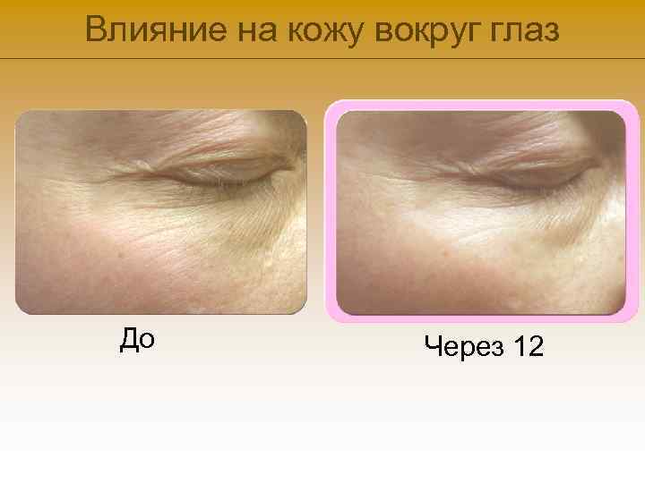 Влияние на кожу вокруг глаз До Через 12 