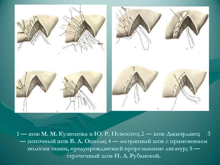 1 — шов М. М. Кузнецова и Ю. Р. Пенского; 2 — шов Джиордано;