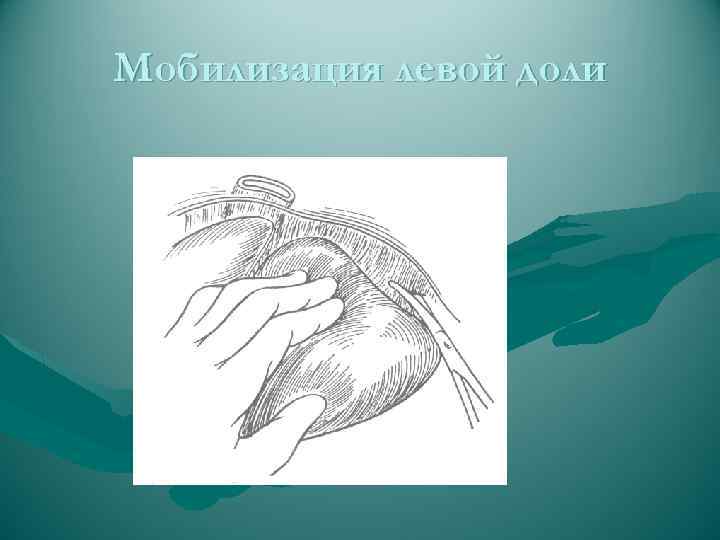 Мобилизация левой доли 