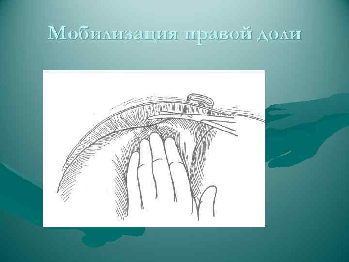 Мобилизация правой доли 