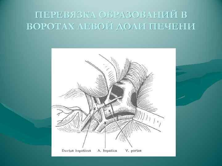 ПЕРЕВЯЗКА ОБРАЗОВАНИЙ В ВОРОТАХ ЛЕВОЙ ДОЛИ ПЕЧЕНИ 