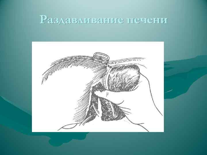 Раздавливание печени 