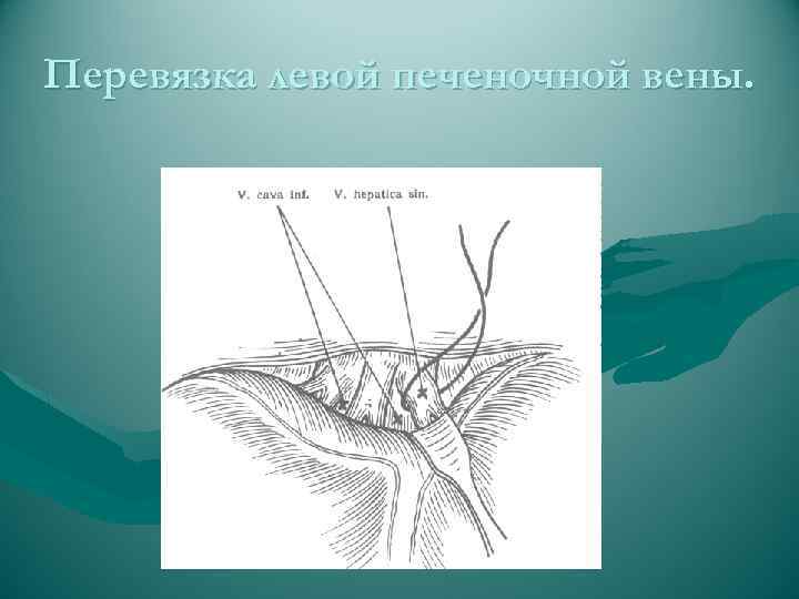 Перевязка левой печеночной вены. 