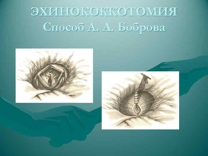 ЭХИНОКОККОТОМИЯ Способ А. А. Боброва 