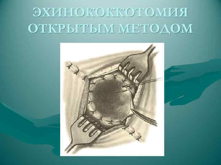 Открытый метод. Открытая эхинококкотомия. Открытая эхинококкэктомия печени.