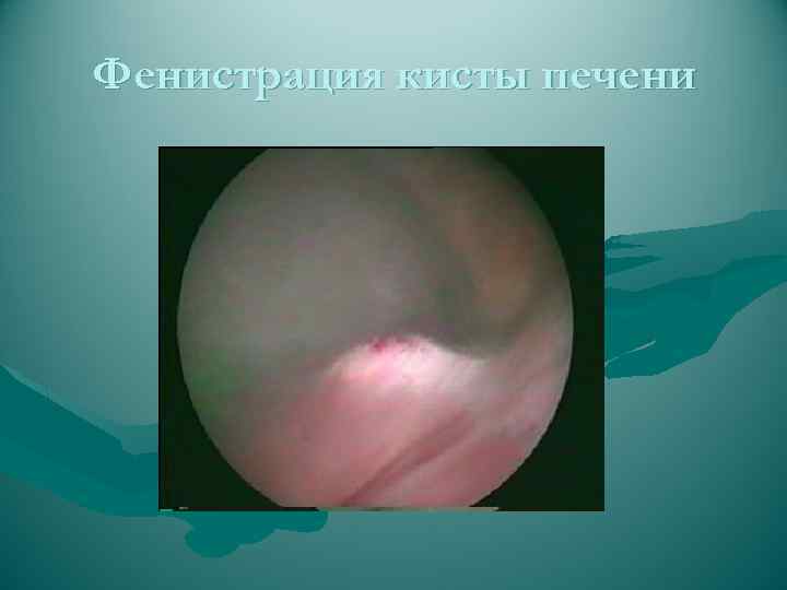 Фенистрация кисты печени 