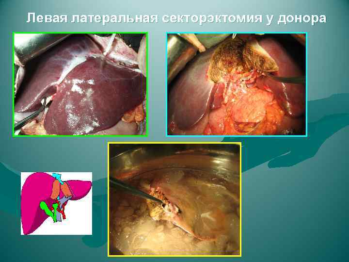 Левая латеральная секторэктомия у донора 
