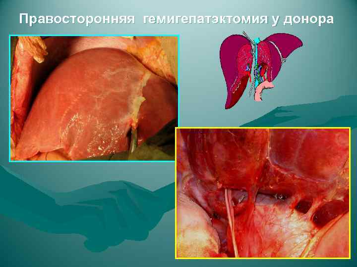 Правосторонняя гемигепатэктомия у донора 
