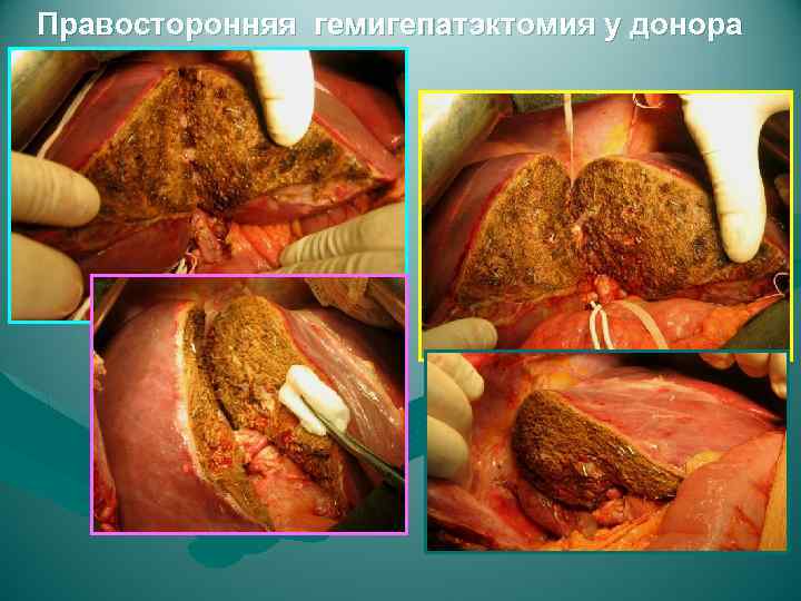 Правосторонняя гемигепатэктомия у донора 