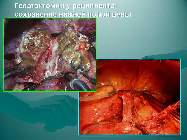 Гепатэктомия у реципиента: сохранение нижней полой вены 