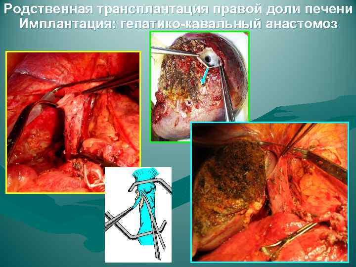 Родственная трансплантация правой доли печени Имплантация: гепатико-кавальный анастомоз 