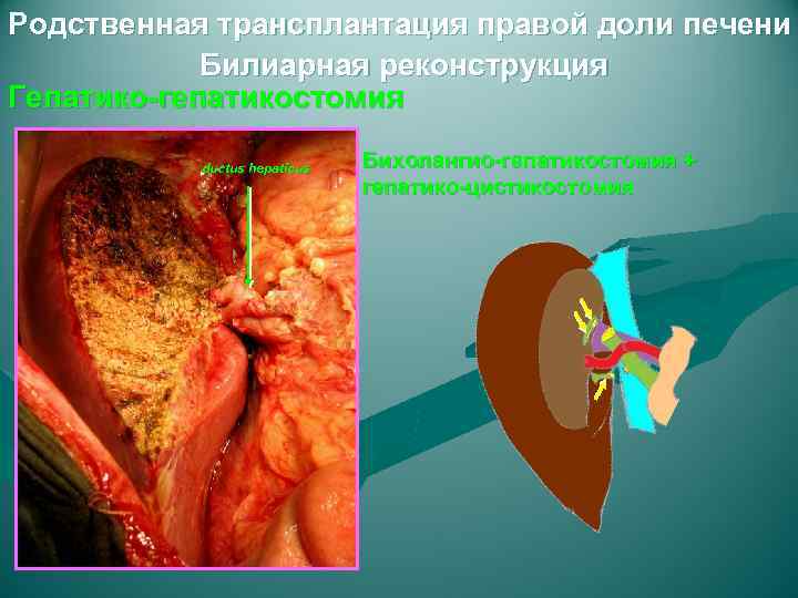 Родственная трансплантация правой доли печени Билиарная реконструкция Гепатико-гепатикостомия ductus hepaticus Бихолангио-гепатикостомия + гепатико-цистикостомия 