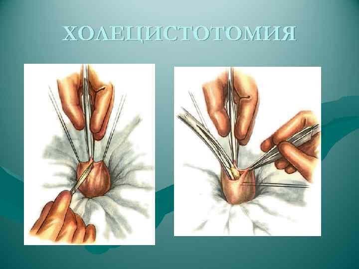 ХОЛЕЦИСТОТОМИЯ 