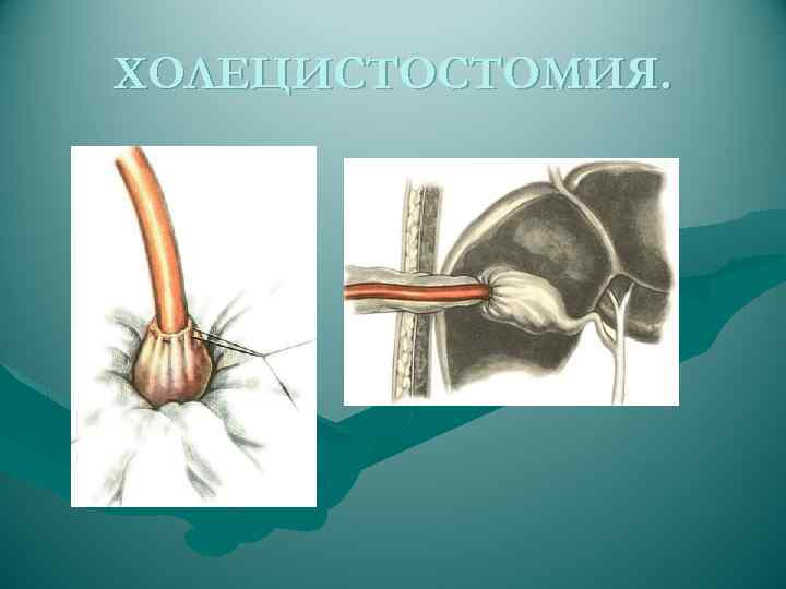 ХОЛЕЦИСТОСТОМИЯ. 