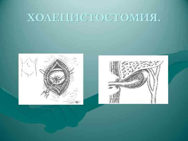ХОЛЕЦИСТОСТОМИЯ. 
